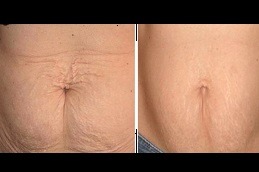 Best Microneedling for Stretch Marks An Effective Solution in Dubai