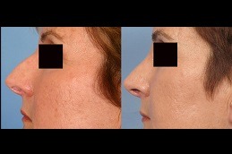 Best Most Common Rhinoplasty Techniques Clinic in Dubai