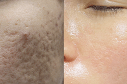 Best Say Goodbye to Scars with Laser Treatment Clinic in Dubai