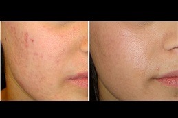 Best Say Goodbye to Scars with Laser Treatment in Dubai