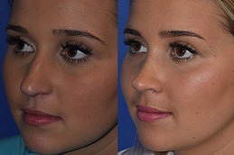 Best The Myths and Facts about Rhinoplasty Surgery in Dubai