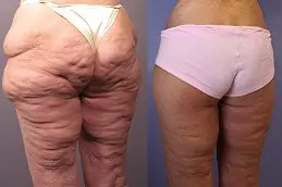 Best What Are The Pros and Cons of a Thigh Lift Clinic in Dubai