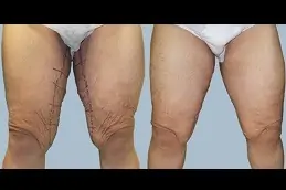 Best What Are The Pros and Cons of a Thigh Lift in Dubai