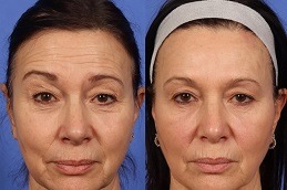 Best Why Do You Glow After Botox in Dubai