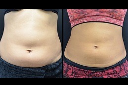 Best Will CoolSculpting Help Me Lose Weight Clinic in Dubai