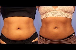 Best Will CoolSculpting Help Me Lose Weight in Dubai