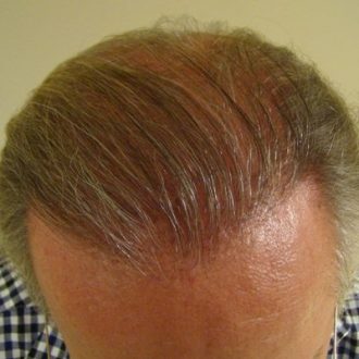 Biofibre Hair Transplantation & Restoration in Dubai