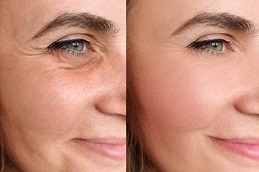 Botox Injection For Face Slimming in Dubai