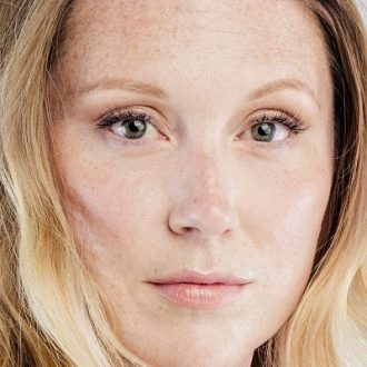 Brow Lift Recovery – What to Expect in Dubai