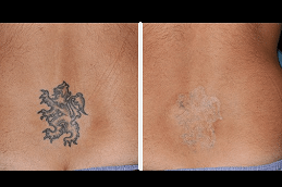 Can Picosure Completely Remove Tattoo in Dubai