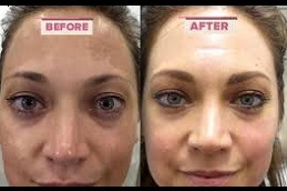 Clinic for melasma treatment in Abu Dhabi