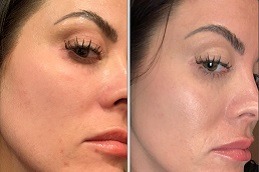 Clinic for melasma treatment in Dubai & Abu Dhabi