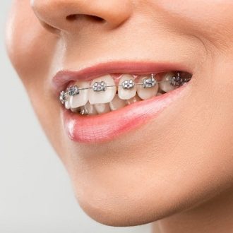 Components of a Fixed Appliance in Dubai