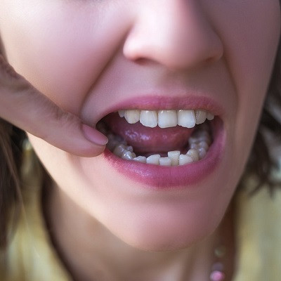 Dental Implants For Crooked Teeth in Dubai