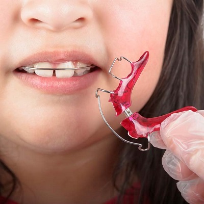 Dental Retainers VS Dental Braces in Dubai