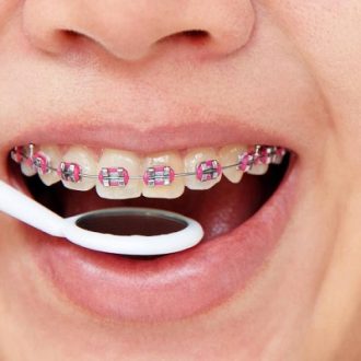 Different Types of Braces in Dubai & Abu Dhabi