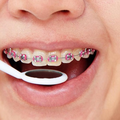 Different Types of Braces in Dubai & Abu Dhabi Price & Cost