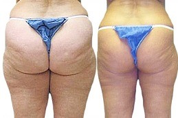 Does Cellulite Get Worse With Age in Dubai