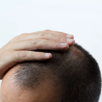 Does Hair Transplant Work for Traction Alopecia