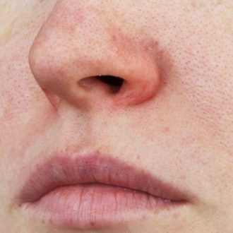 Facial Capillaries: Causes and Solutions in Dubai