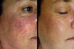 Facial Capillaries Causes and Solutions in Dubai