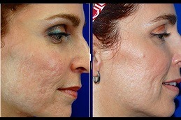 From Microdermabrasion to Lasers Acne Scar Solutions in Dubai