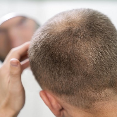 How Long do Hair Transplants Take to Grow in Dubai