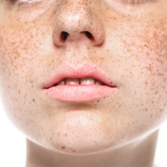 How To Remove Freckles From Your Face