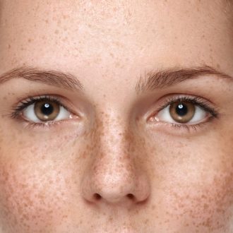 How To Remove Pigmentation From Face Permanently