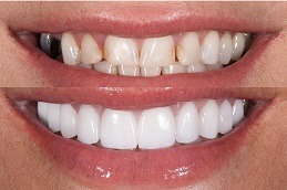 How Veneers Can Change Your Life in Dubai