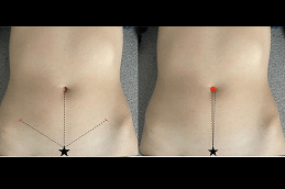 How to Lose Belly Fat After Laparoscopy in Dubai