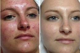 Hydrafacial Benefits For Acne Scars in Dubai