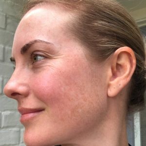 Maximize Your Skincare Routine with Cosmelan Peel