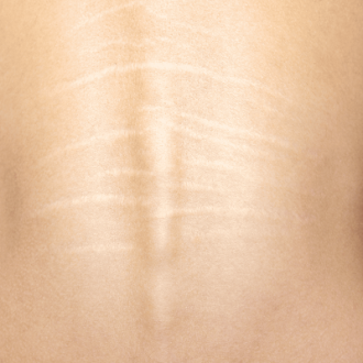 Microneedling for Stretch Marks: An Effective Solution