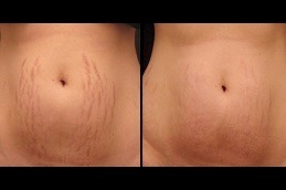 Microneedling for Stretch Marks An Effective Solution in Dubai