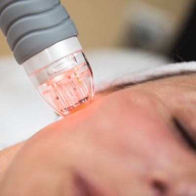 Pros and Cons of (RF) Micro-Needling in Dubai & Abu Dhabi Cost