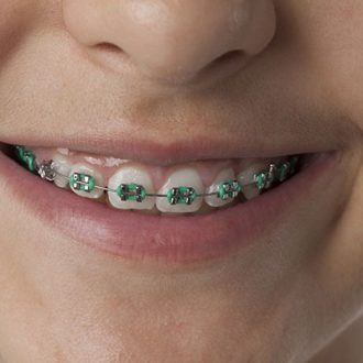 Retainers For Teeth Straightening in Dubai