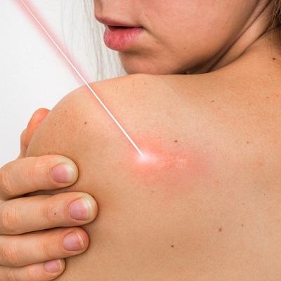 Say Goodbye to Scars with Laser Treatment