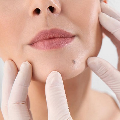 Step-by-Step Guide to Mole Removal in Dubai & Abu Dhabi Cost