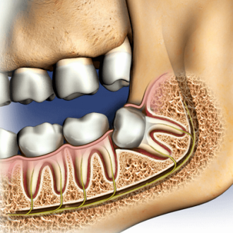 Surgical Wisdom Tooth Removal In Dubai