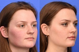The Myths and Facts about Rhinoplasty Surgery in Dubai