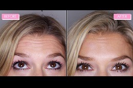 The Power of Botox To Get Your Glow Back in Dubai