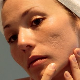 The Ultimate Guide to Treating Acne Scars