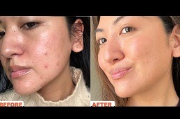 The Ultimate Guide to Treating Acne Scars in Dubai