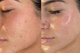 Transform Your Skin with Derma Roller Therapy in Dubai