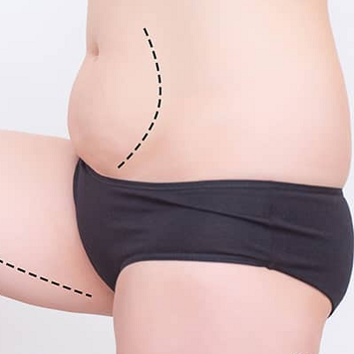 Tummy Tuck Scars: Prevention, Treatment & Removal