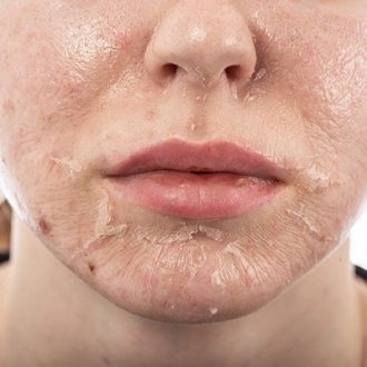 Ultimate Guide To Cosmelan Peel Treatment