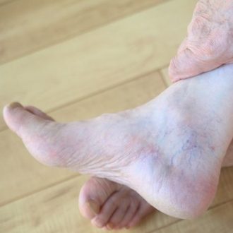 Varicose Veins Treatment Options: Which is Right for You