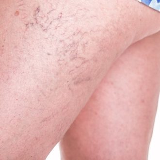 Varicose Veins on the Bum Cheek in Dubai