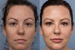 What Age is Best for Fillers in Dubai & Abu Dhabi